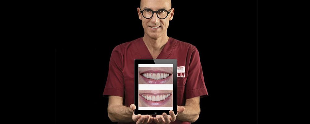 Esthetic Dental Veneers at Vignato Clinic – Vicenza